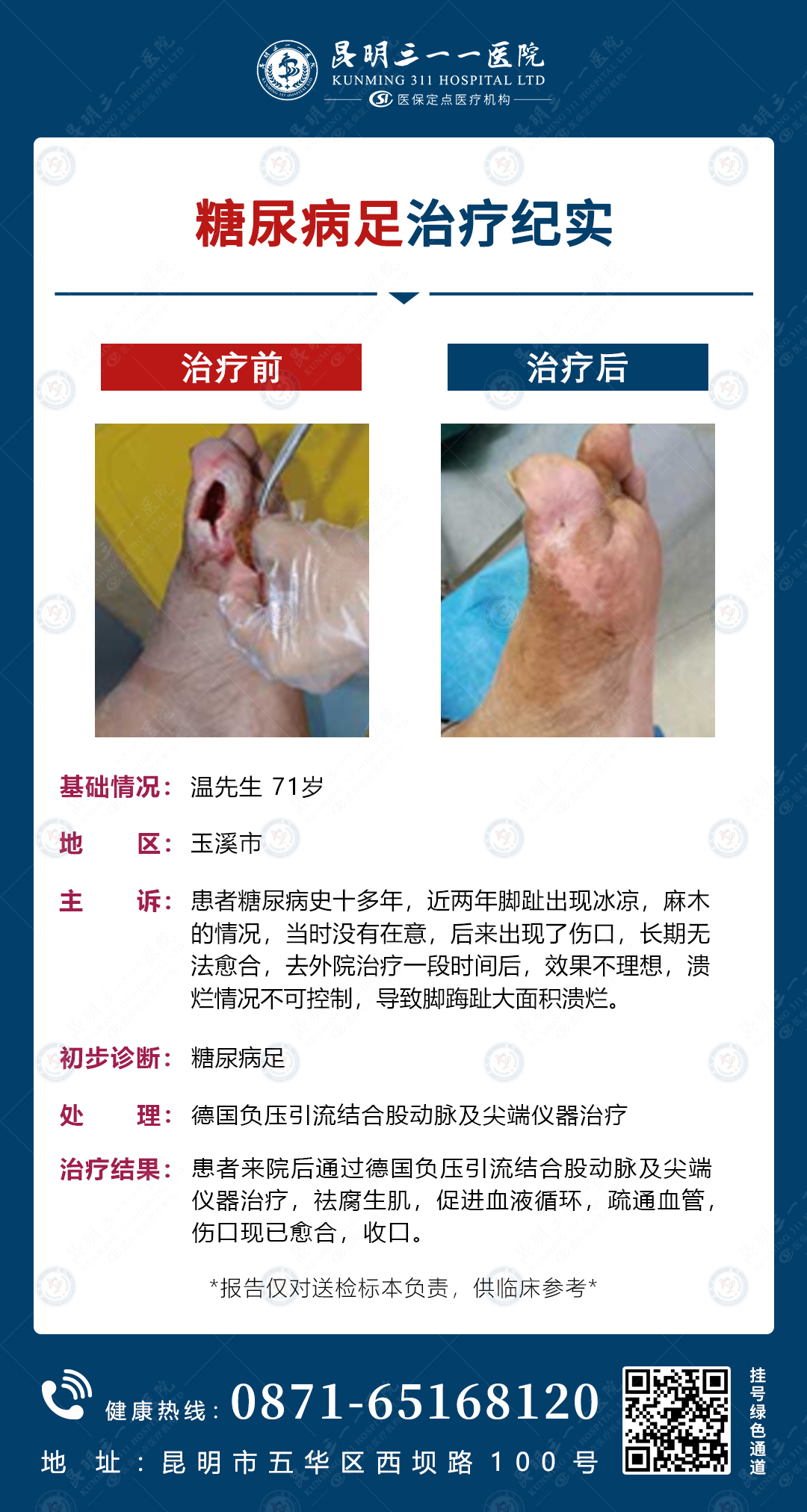 糖尿病足康复奇迹：昆明三一一医院多疗法合一