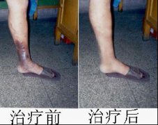 静脉炎疾病是什么？