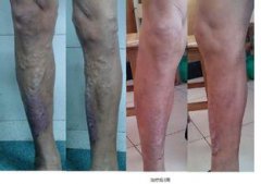 治疗下肢静脉炎的治疗方法有哪些？