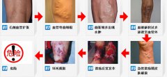 腿肿了怎么消肿？