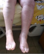 静脉血栓不同时期的症状