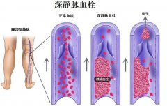 导致下肢水肿的原因有哪些