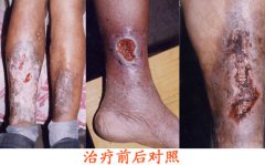 医生支招：如何防治静脉炎