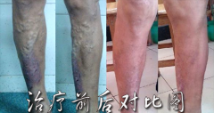 昆明预防静脉炎如何做?