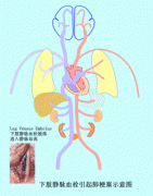得了深静脉血栓会有什么表现?