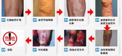 造成静脉血栓的主要原因有什么?
