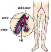 大腿形成静脉血栓的原因有哪些?