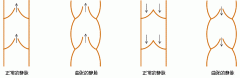 静脉曲张怎么回事?