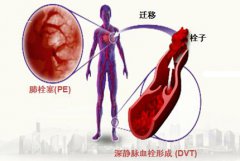 患有下肢深静脉血栓该怎么办