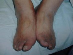 动脉硬化闭塞症辨病要点，你了解吗?