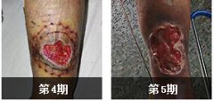 老烂腿有什么特点