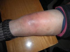 静脉血栓对腿的危害有哪些?