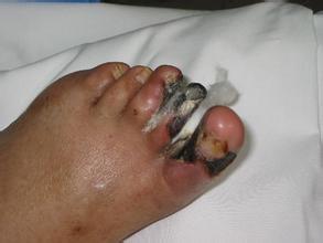 刘伯，动脉硬化