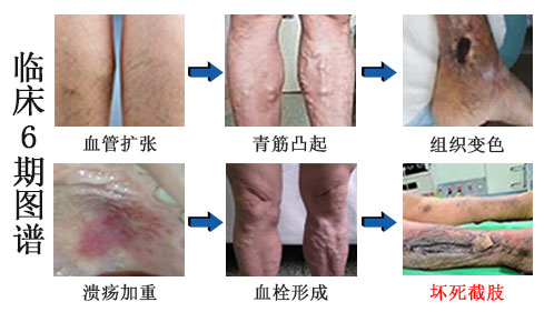 静脉曲张治疗方法