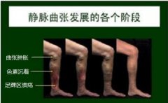 脚静脉曲张？怎么治疗效果好