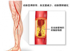 动脉硬化是怎么回事?