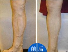 8年静脉曲张终于在此治愈