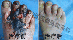 脉管炎怎么治疗好