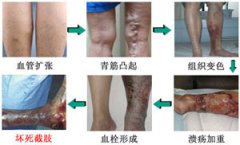 静脉曲张给我们生活带来哪些危害