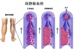 静脉血栓是怎么形成的