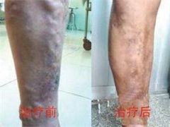 柳先生的静脉血栓康复案例