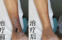静脉炎有什么症状