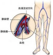 静脉血栓形成的典型症状