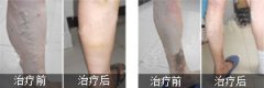 详解静脉曲张产生的原因