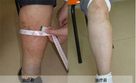 腿部静脉血栓的症状是什么样的