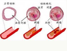 动脉硬化形成的原因