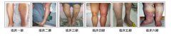 昆明三一一医院助你认清小腿曲张症状
