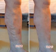老教师腿上为何会出现蚯蚓状血管凸起？