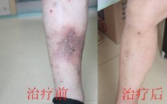 寻根究竟：下肢静脉曲张是由哪些原因引起?
