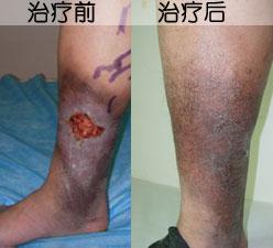中医角度看老烂腿病因 治疗老烂腿好的方法