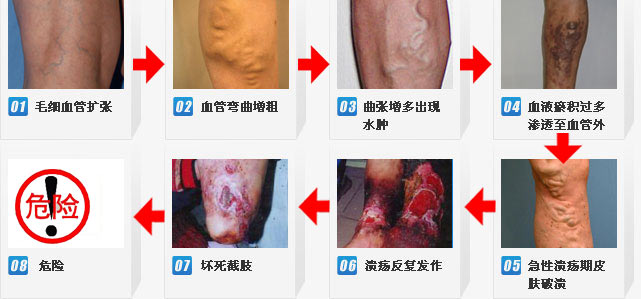 昆明三一一医院告诉您静脉曲张七大症状