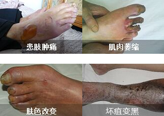 老烂腿怎么治?昆明三一一医院有绝招