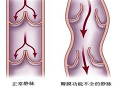 小腿皮肤上的青筋特别明显这是为什么