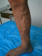 腿上出现蚯蚓状凸起，是什么病