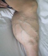 腿部青筋