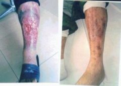 引起老烂腿疾病的周围血管病有哪些？