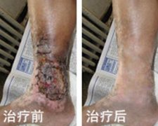 老烂腿传统的方法可以治好吗