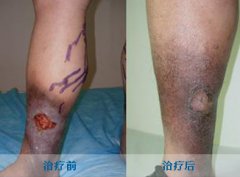 老烂腿的治疗方法