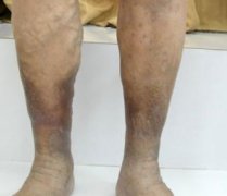 动脉硬化治疗该挂什么科