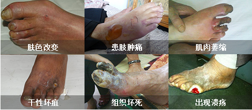 动脉硬化的危害有哪些?