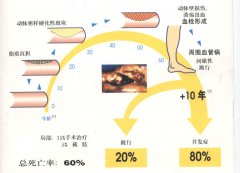 动脉硬化是怎么回事?