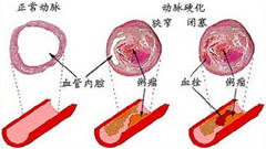 动脉硬化是怎么回事 在楚雄怎么治疗