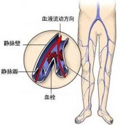 上班族久坐莫被“深静脉血栓”缠上