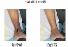 下肢“老烂腿”，发生溃疡后能否治愈？