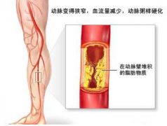 治疗下肢动脉硬化最好的方法是什么？