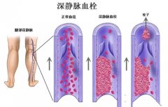 医生为您解答静脉血栓到底是如何引发的呢？